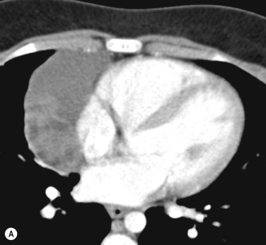 Fig. 4.4, Cystic Thymoma.