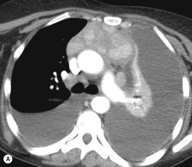 Fig. 4.5, Invasive Thymoma.