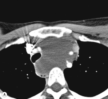 Fig. 4.9, Thymic Cyst.