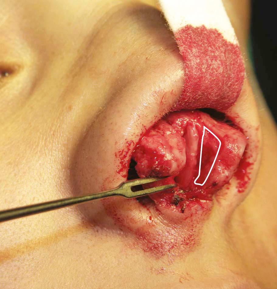 Figure 13-6, Anterior approach to septum. The medial crura are separated and the membranous septum is dissected through to expose the caudal septum. The membranous septum, separating the left lower lateral cartilage and the caudal septum, is indicated by the white line.