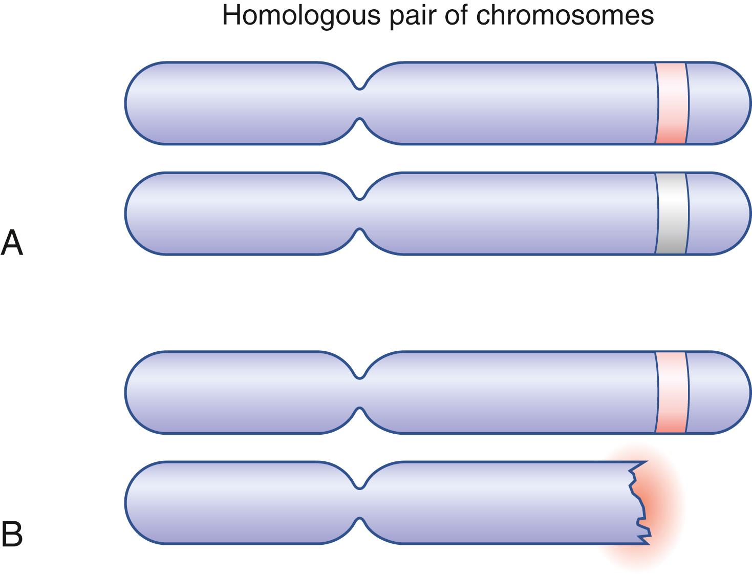 Fig. 41.1, Illustration of somatic mutation leading to loss of function of the menin gene in heterozygous individuals. (A) Normal allele. (B) Somatic mutation affects normal allele.