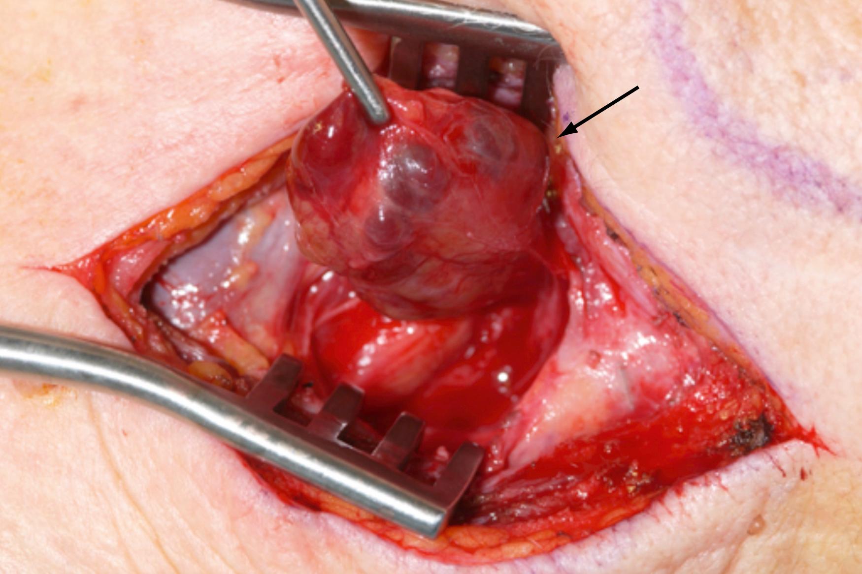 Fig. 41.3, Parathyroid adenoma with asymmetric hyperplasia, indicated by arrow .