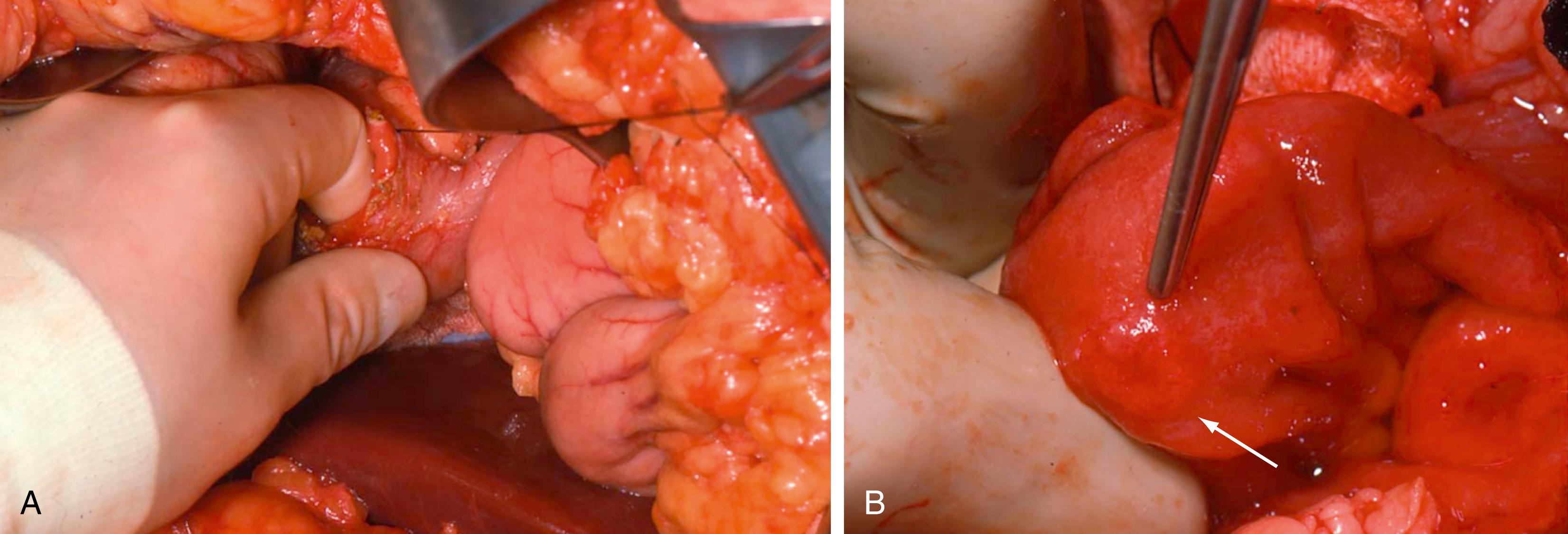 Fig. 41.4, Gastrinoma, intraoperative findings. (A) Duodenotomy and palpation of the duodenal wall. (B) Typical appearance of a gastrinoma in the duodenal wall, indicated by arrow .