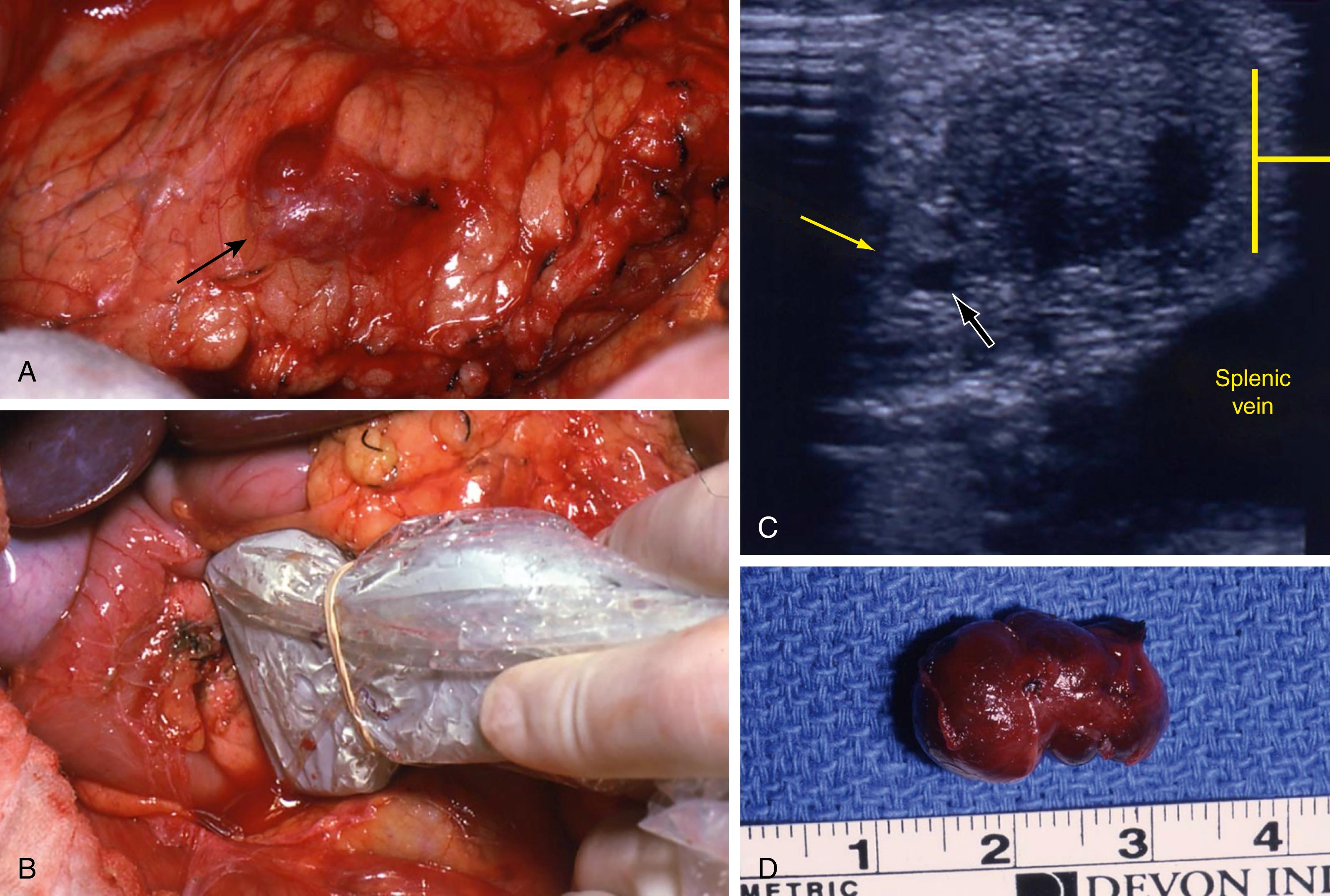 Fig. 41.5, Insulinoma. (A) Insulinoma, reddish in appearance, posterior body of pancreas, indicated by arrow . (B) Intraoperative ultrasound used to identify insulinoma and define relationship to vessels and pancreatic duct. (C) Ultrasound image of insulinoma. (D) Resected insulinoma.