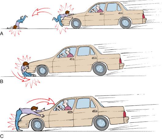 Fig. 5.1, Different injury patterns resulting from a similar car-versus-pedestrian mechanism. (A) A typical Waddell triad in which the child sustains an ipsilateral femoral and chest injury from the initial impact of the car and is then thrown forward and strikes the contralateral side of the head on the ground. (B) A smaller child being struck by the car and sustaining chest and head injuries from a direct blow on the bumper and then sustaining lower extremity crush injuries from being dragged underneath the car. (C) An adolescent being struck, sustaining tibia or knee injuries from the bumper, and then being thrown forward and sustaining chest, head, and neck injuries from impact on the windshield.