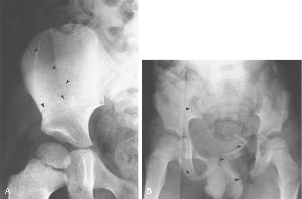 Fig. 5.3, (A) Anteroposterior radiograph of a 4-year-old child demonstrating a nondisplaced stable fracture of the iliac wing (arrow heads) with no associated intrapelvic or intraabdominal injuries. (B) Anteroposterior pelvic radiograph of a 5-year-old child who was run over by a truck and sustained multiple pelvic injuries (arrow heads) and multiple associated injuries, including proximal femoral fractures, degloving soft tissue injuries, rectal perforation, and bladder rupture.