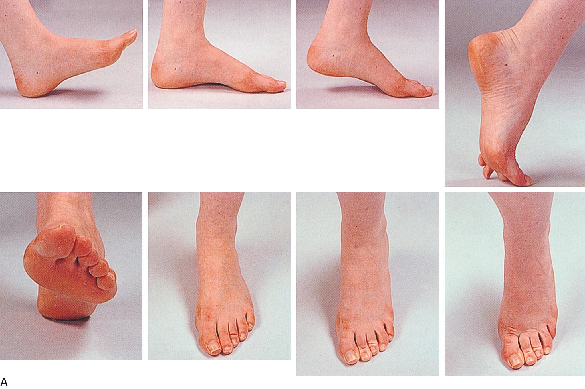 Fig. 20.23, (A and B) Positions of the foot in the normal gait cycle.