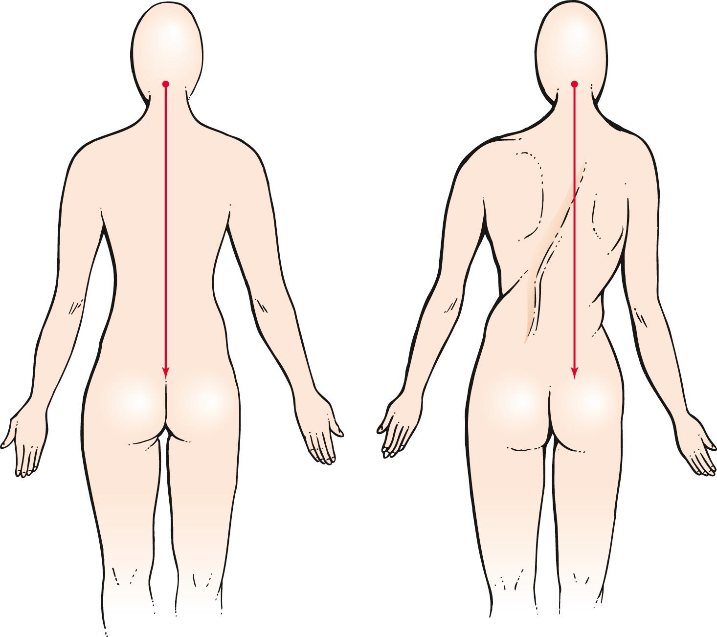 Fig. 20.24, Technique for Evaluating “Straightness” of the Spine.
