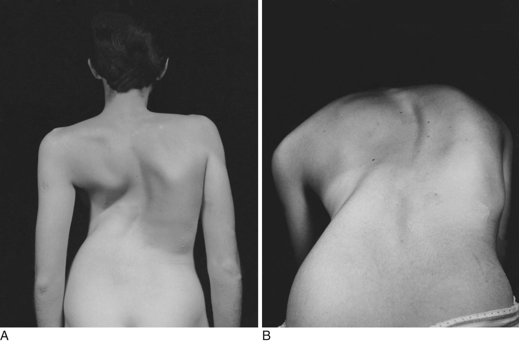 Fig. 20.25, (A) Severe kyphoscoliosis. (B) Patient asked to bend forward.