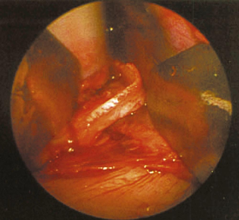 Fig. 29.1, Intraoperative image shows a septal spur with cartilage and bone overlap beginning at the bony-cartilaginous junction of the septum and proceeding posteriorly. This cartilage strip can be used for grafting material, if no other source of autologous cartilage is available.