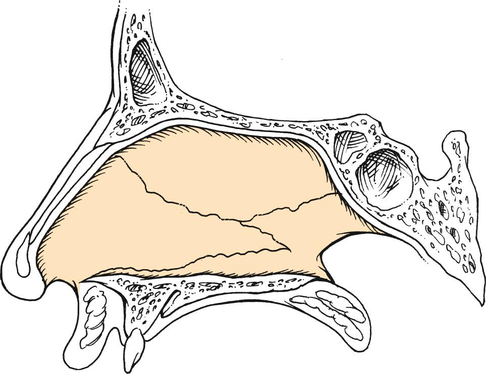 Fig. 29.2, This lateral schematic depicts one of the many configurations of the bony and cartilaginous septa, which vary substantially from patient to patient. However, what is fairly consistent is the posterior triangular segment of cartilaginous septum, which often overlaps the bony septum.