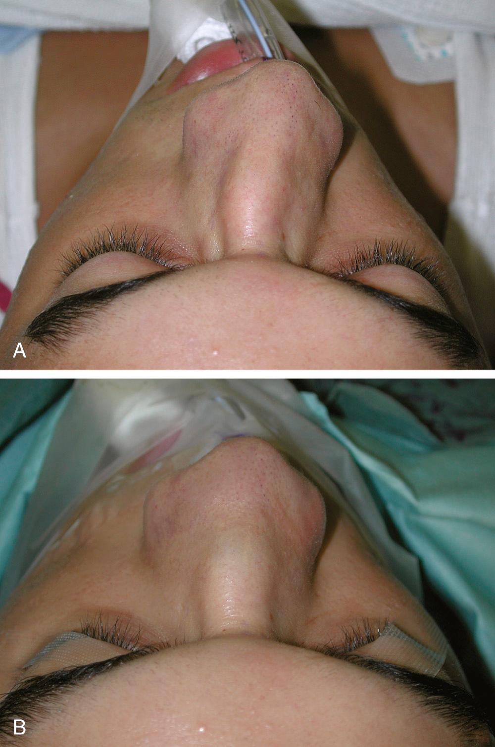 Fig. 29.4, (A) Deviated nose before septoplasty. (B) The significant correction of the deviated nose with septoplasty alone makes it incumbent on surgeons to always straighten the deviated septum before any lateral or medial osteotomies are done.