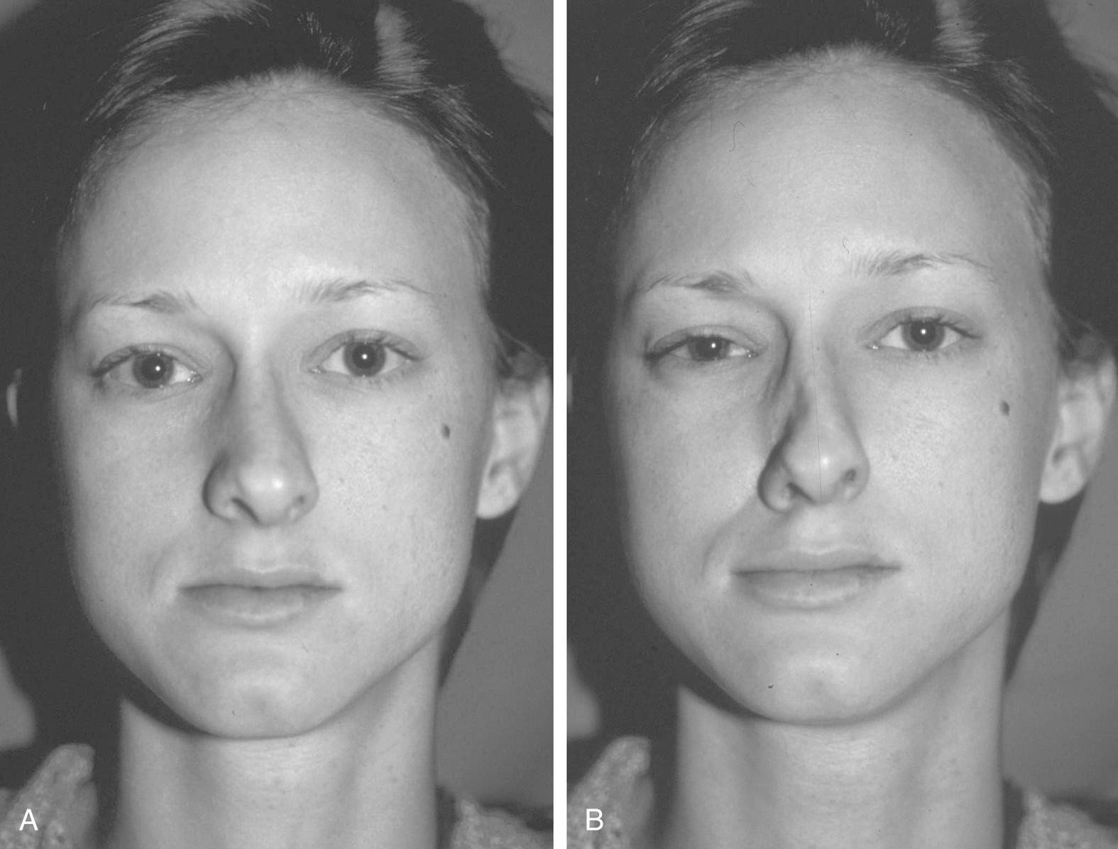 Fig. 29.5, (A) Patient breathing through the nose at rest. (B) Collapse of the nasal side wall inclusive of nasal valve with forced inspiration.