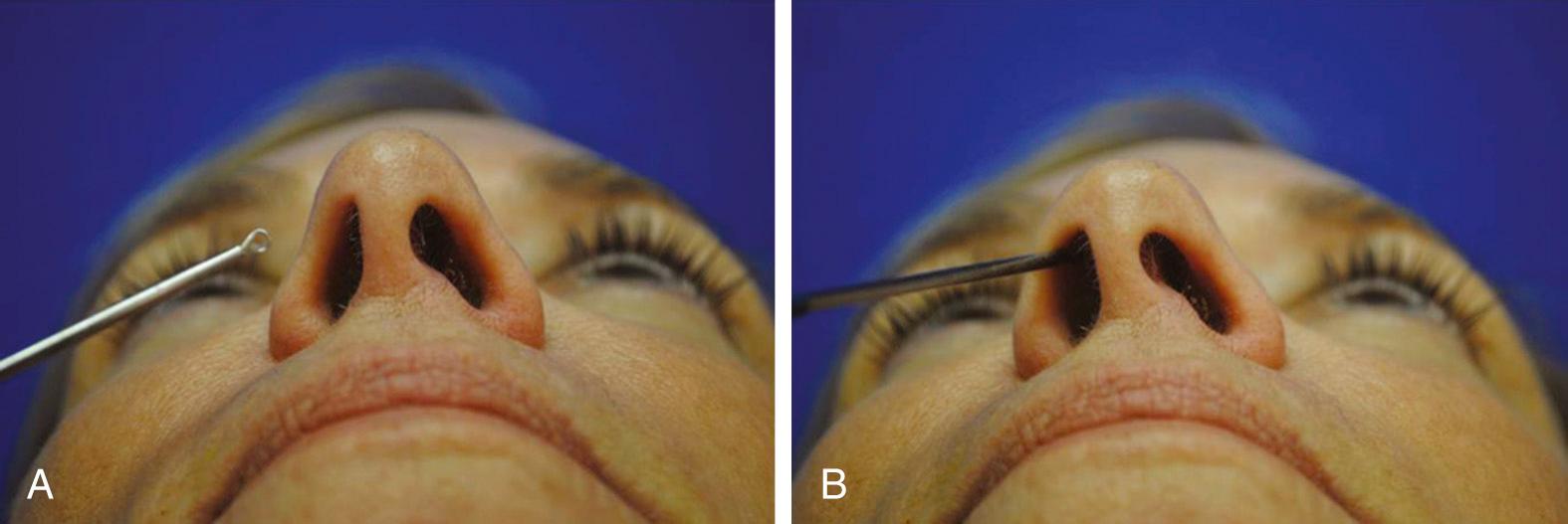 Fig. 29.6, (A) External evaluation of the patient's nose should also include evaluation of the internal nasal valve. The Cottle maneuver is not always a reliable indicator, with many false-positive results because of the large mass movement. A cotton-tipped applicator, cerumen curette, or similar instrument is a more specific way to evaluate the internal nasal valve. (B) Gentle lateralization with a cotton-tipped applicator or cerumen curette specifically increases the internal nasal valve angle, and in those with a narrow angle, it may improve airflow and alleviate the sensation of nasal obstruction. Such patients often benefit from spreader grafts.