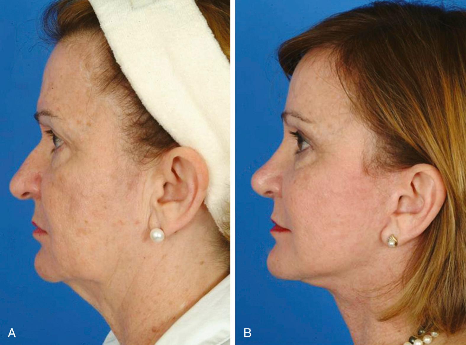 Fig. 29.7, Tip ptosis can contribute to nasal obstruction by preventing adequate airflow into the nasal airway. (A) Preoperative view of a patient with tip ptosis and an acute nasolabial angle. (B) Postoperative view after a septoplasty and rhinoplasty with rotation of the tip. The patient had markedly improved breathing postoperatively.