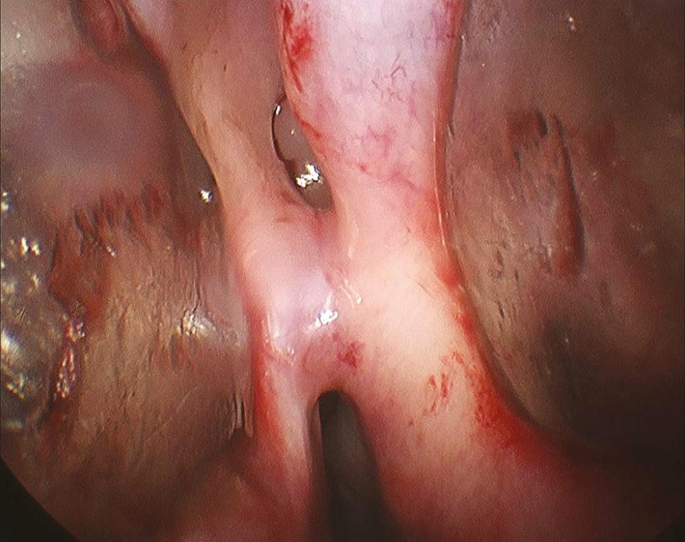 Fig. 29.9, Intraoperative image shows scar band from septum to the inferior turbinate with nasal speculum on either side.