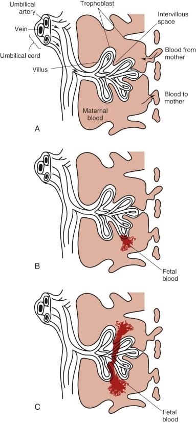 Figure 2-4, Anatomic issues in fetomaternal hemorrhage. A, Resting state: fragile capillary networks are present. B, A minor small bleed, known to occur in almost all pregnancies. C, A major possibility of significant exchange of fetal and maternal blood as a result of abruption (more severe) or normal childbirth.