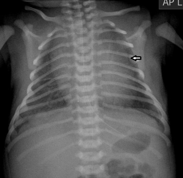 Fig. 70.1, Mediastinal Widening, Due to Normal Thymic Tissue.