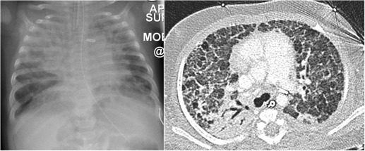 Fig. 70.11, Premature Infant Ventilated for Idiopathic Respiratory Distress Syndrome.