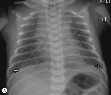 Fig. 70.12, (A) Term infant. Radiograph shows mild hyperinflation, prominent vasculature, interstitial opacification most marked in the lower lobes and small pleural effusions (arrows) suggestive of transient tachypnoea of the newborn. (B) There is almost complete resolution at 24 hours.