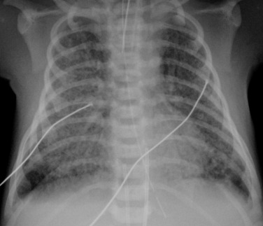 Fig. 70.13, Infant Born at 42 Weeks’ Gestation.