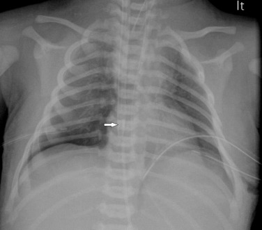 Fig. 70.14, Term Infant With Meconium Aspiration Undergoing Extracorporeal Membrane Oxygenation.