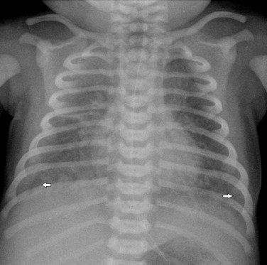 Fig. 70.15, Infant With Group B Streptococcus Infection.