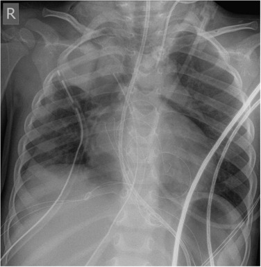 Fig. 70.16, Post-Operative Pneumomediastinum Outlining and Elevating the Thymus.