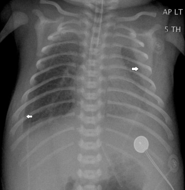 Fig. 70.17, Newborn With Bilateral Chylothoraces.