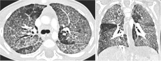 Fig. 70.18, Infant With Pulmonary Alveolar Proteinosis (PAP) Secondary to a Surfactant Dysfunction Disorder.