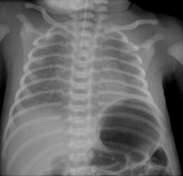 Fig. 70.2, Infant Born at 26 Weeks’ Gestation.