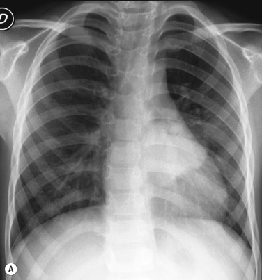 Fig. 70.25, Round Pneumonia.