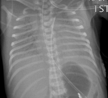 Fig. 70.3, Premature Infant With Severe Idiopathic Respiratory Distress Syndrome.