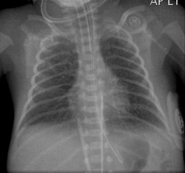 Fig. 70.5, Very Premature Infant Born at 24 Weeks’ Gestation.