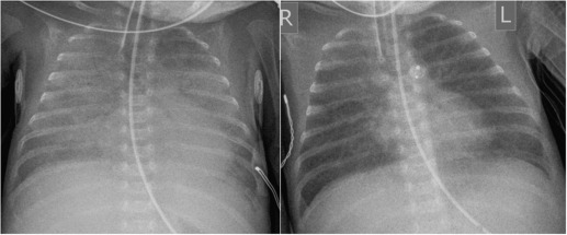 Fig. 70.6, Left : There is cardiac enlargement and widespread hazy airspace opacification, suggestive of a left-to-right shunt, in this case via a large patent ductus arteriosus (PDA). Right : Thirty minutes post-device occlusion of the PDA, the airspace opacification (oedema) has improved and the heart appears smaller.