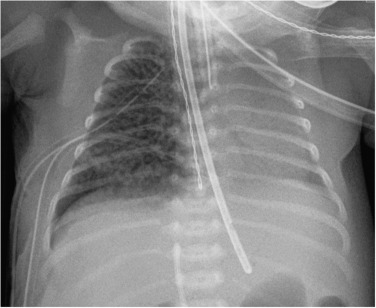 Fig. 70.7, Pulmonary Interstitial Emphysema (PIE).