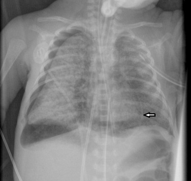 Fig. 70.8, Pneumopericardium.