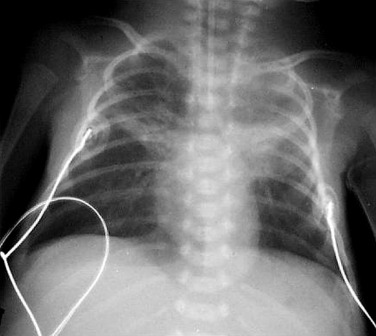 Fig. 70.9, Bilateral Upper Lobe Segmental Atelectasis.