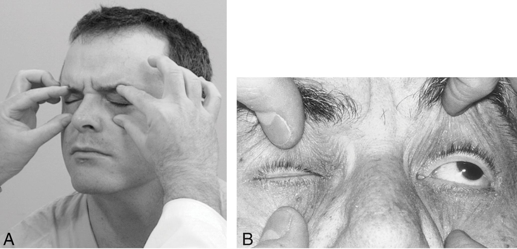 Fig. 17.2, (A) and (B) Testing the strength of eyelid closure.