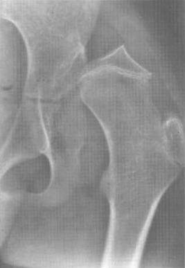 Fig. 82.1, Radiograph of a hip demonstrating the “triangulation” effect with flattening of the superolateral femoral head caused by spastic hip abductors and a tight superior capsule, and medial notching of the head caused by the ligamentum teres.