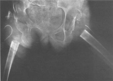Fig. 82.3, Anteroposterior radiograph of a pelvis demonstrating bilateral proximal femoral resections.