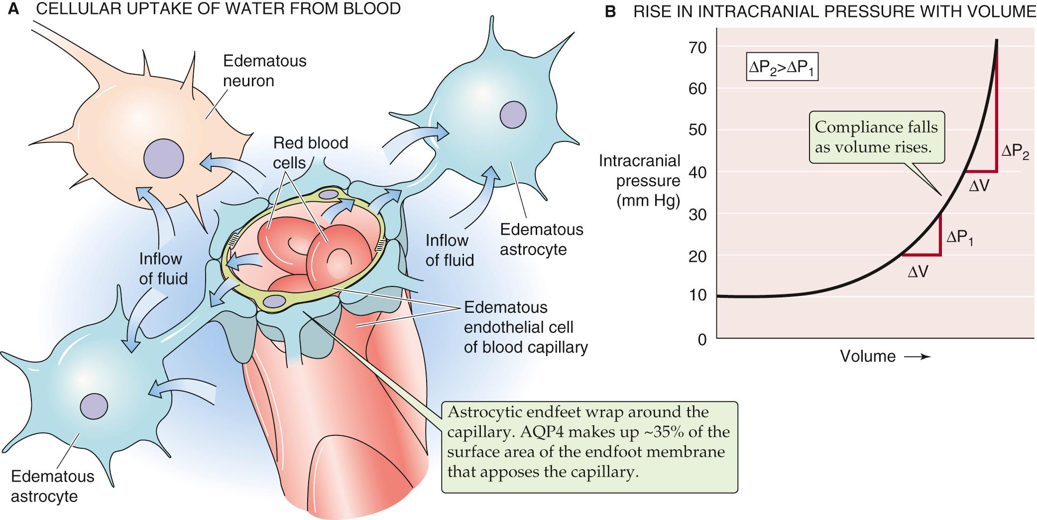 Figure 11-6, Cerebral edema. A, In cerebral edema, the brain fluid that accumulates comes from the vascular compartment. Cell swelling due to the mere shift of fluid from the extracellular to the intracellular fluid is not cerebral edema. B, Although small increases in intracranial volume have little effect on pressure, additional increases in volume cause potentially life-threatening increases in pressure. Note that compliance (i.e., Δ V /Δ P ) falls at increasing volumes.