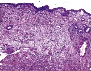 Figure 14.1, Lower uterine segment mucosa, or ‘isthmic endometrium.’ In a hysterectomy specimen, the isthmic endometrium is seen as a zone of poorly developed glands in fibrous stroma, which lack the cyclical hormonally induced changes of endometrium within the uterine corpus.