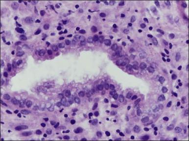 Figure 14.11, Endometrial stroma. Late secretory phase (day 27), compact layer. The stromal cells surrounding the gland show predecidual change and have abundant cytoplasm. Granulated lymphocytes are present.