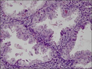 Figure 14.13, Endometrial stroma. Late secretory phase (day 27), spongy layer. The glands are active but the stromal cells are small with no decidual change.