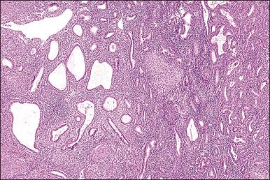 Figure 14.14, Smooth muscle in endometrial stroma.