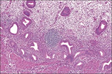 Figure 14.15, Normal endometrium. Lymphoid aggregate.