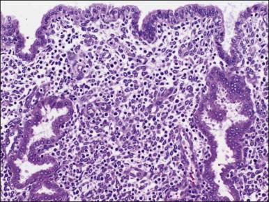 Figure 14.6, Surface epithelium, late secretory endometrium. Note contrast of surface at top to glands below.