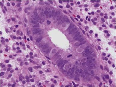 Figure 14.9, Clear cells in glandular epithelium.