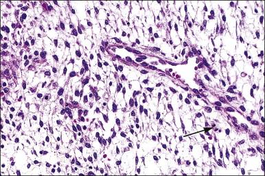 Figure 14.10, Endometrial stroma. Proliferative phase. Stromal mitotic activity (arrow) is seen. Part of a spiral arteriole is present.